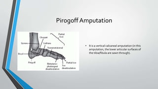 Pirogoff Amputation
• It is a vertical calcaneal amputation (in this
amputation, the lower articular surfaces of
the tibia/fibula are sawn through).
 