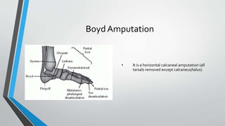 Boyd Amputation
• It is a horizontal calcaneal amputation (all
tarsals removed except calcaneus/talus).
 