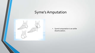 Syme’s Amputation
• Syme’s amputation is an ankle
disarticulation.
 