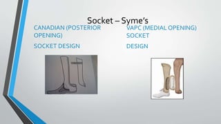 Socket – Syme’s
CANADIAN (POSTERIOR
OPENING)
SOCKET DESIGN
VAPC (MEDIAL OPENING)
SOCKET
DESIGN
 