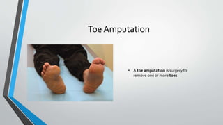 Toe Amputation
• A toe amputation is surgery to
remove one or more toes
 
