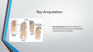 Ray Amputation
• Ray amputations are the removal of an
entire finger along with the corresponding
metatarsal bones in the foot.
 