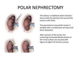 POLAR NEPHRECTOMY
The kidney is mobilized within Gerota's
fascia while the perirenal fat around the
tumor is left intact
The parenchyma around the tumor is
divided with a combination of sharp and
blunt dissection
After excision of the tumor, the
remaining transected blood vessels on
the renal surface are secured with
figure-of-eight 4-0 chromic sutures
 
