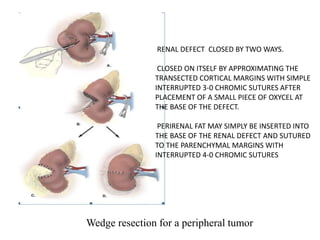 Wedge resection for a peripheral tumor
RENAL DEFECT CLOSED BY TWO WAYS.
CLOSED ON ITSELF BY APPROXIMATING THE
TRANSECTED CORTICAL MARGINS WITH SIMPLE
INTERRUPTED 3-0 CHROMIC SUTURES AFTER
PLACEMENT OF A SMALL PIECE OF OXYCEL AT
THE BASE OF THE DEFECT.
PERIRENAL FAT MAY SIMPLY BE INSERTED INTO
THE BASE OF THE RENAL DEFECT AND SUTURED
TO THE PARENCHYMAL MARGINS WITH
INTERRUPTED 4-0 CHROMIC SUTURES
 