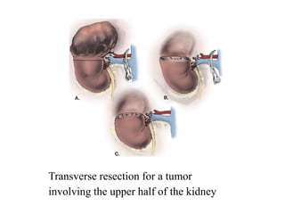 Transverse resection for a tumor
involving the upper half of the kidney
 