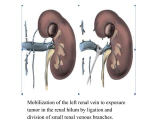 Mobilization of the left renal vein to exposure
tumor in the renal hilum by ligation and
division of small renal venous branches.
 