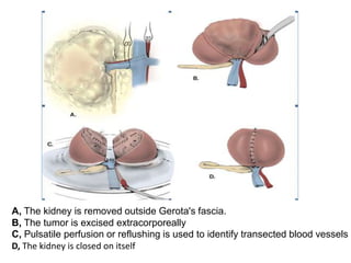 A, The kidney is removed outside Gerota's fascia.
B, The tumor is excised extracorporeally
C, Pulsatile perfusion or reflushing is used to identify transected blood vessels
D, The kidney is closed on itself
 