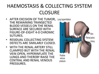 HAEMOSTASIS & COLLECTING SYSTEM
CLOSURE
• AFTER EXCISION OF THE TUMOR,
THE REMAINING TRANSECTED
BLOOD VESSELS ON THE RENAL
SURFACE ARE SECURED WITH
FIGURE-OF-EIGHT 4-0 CHROMIC
SUTURES.
• RESIDUAL COLLECTING SYSTEM
DEFECTS ARE SIMILARLY CLOSED.
• WITH THE RENAL ARTERY STILL
CLAMPED BUT WITH THE RENAL
VEIN OPEN, HYPERINFLATE THE
LUNGS AND THEREBY RAISE THE
CENTRAL AND RENAL VENOUS
PRESSURES.
 
