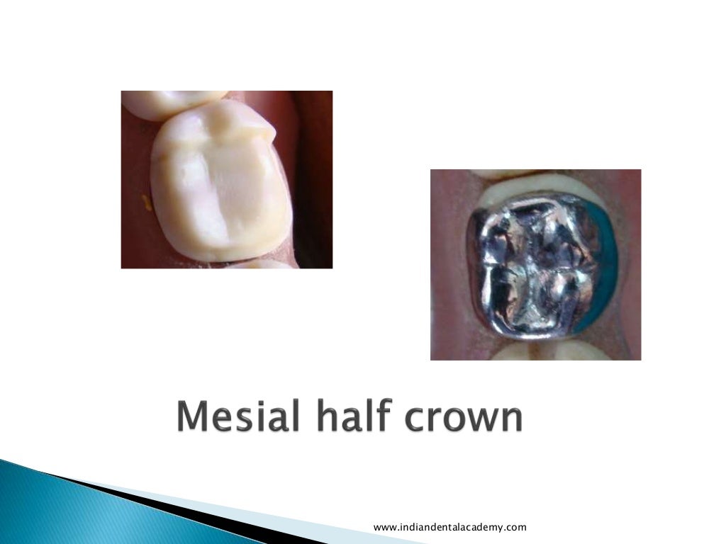 Partial veneer crown pics/ orthodontic straight wire technique