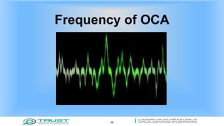 Frequency of OCA
48
 