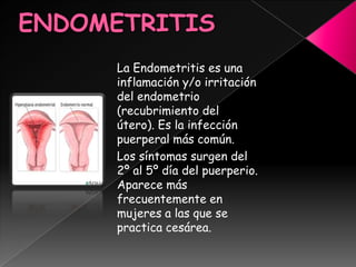 ENDOMETRITIS<br /> <br />La Endometritis es una inflamación y/o irritación del endometrio (recubrimiento del útero). Es la...