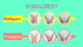 Multípara
Primigesta
 