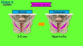 Elevador del ano
Normal Embarazo
3-5 mm Hipertrofia
 
