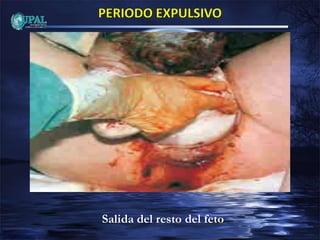 Salida del resto del feto
 