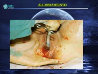 ALUMBRAMIENTO
 
