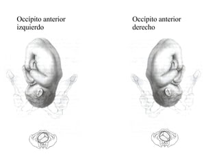 Occípito anterior izquierdo  Occípito anterior derecho 