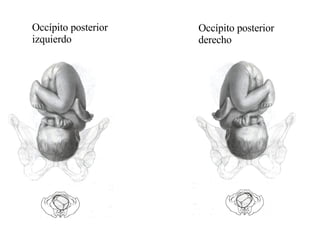 Occípito posterior izquierdo  Occípito posterior derecho 