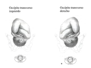 Occípito transverso izquierdo  Occípito transverso derecho 