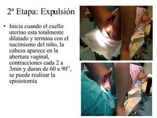 2ª Etapa: Expulsión Inicia cuando el cuello uterino esta totalmente dilatado y termina con el nacimiento del niño, la cabeza aparece en la abertura vaginal, contracciones cada 2 a 3min y duran de 60 a 90”, se puede realizar la episiotomía  