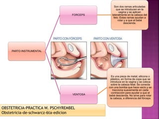 PARTO INSTRUMENTAL
FORCEPS
Son dos ramas articuladas
que se introducen en la
vagina y se aplican
lateralmente en la cabeza del
feto. Estas ramas ayudan a
rotar y a que el bebé
descienda.
VENTOSA
Es una pieza de metal, silicona o
plástico, en forma de copa que se
introduce en la vagina y se coloca
sobre la cabeza fetal. Se conecta
con una bomba que hace vacío y se
tracciona suavemente en cada
contracción para ayudar a que el
bebé descienda. No sirve para rotar
la cabeza, a diferencia del fórceps
OBSTETRICIA-PRACTICA W. PSCHYREMBEL
Obstetricia-de-schwarcz-6ta-edicion
 