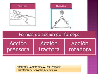 Formas de acción del fórceps
Acción
prensora
Acción
tractora
Acción
rotadora
Tracción Rotación
OBSTETRICIA-PRACTICA W. PSCHYREMBEL
Obstetricia-de-schwarcz-6ta-edicion
 