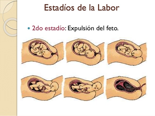 Parto - Puerperio - Repercusiones en el Embarazo