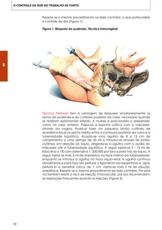 O CONTROLE DA DOR NO TRABALHO DE PARTO



                    Repete-se o mesmo procedimento no lado contrário, o que potencializa
                    o controle da dor (Figura 1).

                    Figura 1. Bloqueio do pudendo. Técnica transvaginal




8




                    Técnica Perineal: tem a vantagem de bloquear simultaneamente os
                    ramos do pudendo e do cutâneo posterior da coxa, necessário quando
                    se realizam episiotomias laterais. A mulher e posicionada e preparada
                    como no caso anterior. Palpa-se a espinha ciática com o indicador
                    através da vagina. Pode-se fazer um pequeno botão cutâneo de
                    anestésico local no ponto médio entra a comissura posterior da vulva e a
                    tuberosidade isquiática. Acopla-se uma agulha de 8 a 12 cm de
                    comprimento a uma seringa de 20 ml e introduz-se através do botão
                    cutâneo em direção ao ísquio, dirigindo-se a agulha com o auxílio do
                    indicador até a tuberosidade isquiática. A seguir injeta-se 5 - 10 ml de
                    lidocaína a 1% com adrenalina 1: 200.000 por fora e para trás do ísquio. A
                    seguir injeta-se mais 5 ml de anestésico na face interna da tuberosidade,
                    enquanto se introduz a agulha na fossa ísquio-retal. A agulha continua
                    dorsalmente e para fora ate perfurar o ligamento sacroespinhoso e, após
                    perfurá-lo e penetrar cerca de 1 cm, injeta-se mais 5 ml de solução
                    anestésica. Repete-se o mesmo procedimento do lado contrário. Por esta
                    via também existe o risco de injeção intravascular, por isso recomendam-
                    se aspirações frequentes durante as injeções (Figura 2).




    72
 