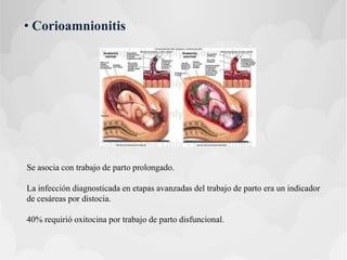 • Corioamnionitis
Se asocia con trabajo de parto prolongado.
La infección diagnosticada en etapas avanzadas del trabajo de parto era un indicador
de cesáreas por distocia.
40% requirió oxitocina por trabajo de parto disfuncional.
 