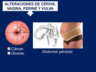 ALTERACIONES DE CÉRVIX,
VAGINA, PERINÉ Y VULVA
Cáncer.
Úlceras. Abdomen péndulo
 