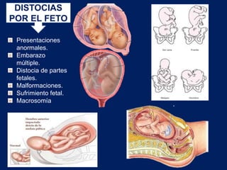 DISTOCIAS
POR EL FETO
Presentaciones
anormales.
Embarazo
múltiple.
Distocia de partes
fetales.
Malformaciones.
Sufrimiento fetal.
Macrosomía
 