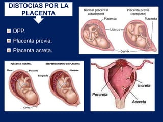 DISTOCIAS POR LA
PLACENTA
DPP.
Placenta previa.
Placenta acreta.
 