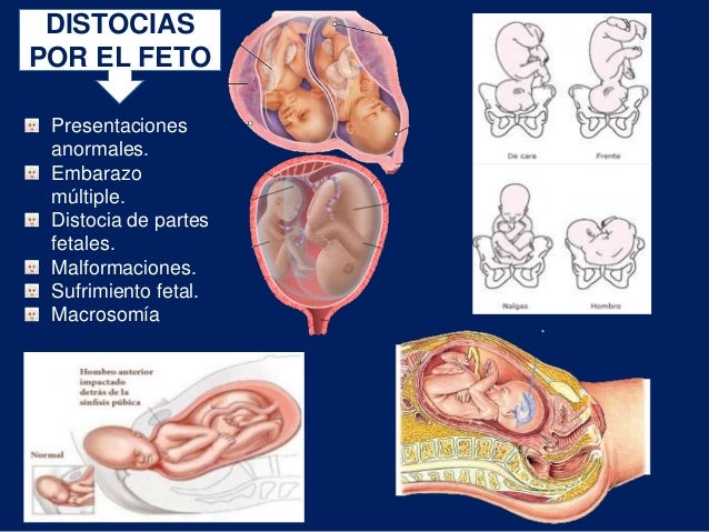 Parto distócico