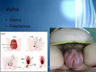 Maniobras para liberar hombro