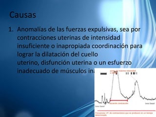 CausasAnomalías de las fuerzas expulsivas, sea por contracciones uterinas de intensidad insuficiente o inapropiada coordinación para lograr la dilatación del cuello uterino, disfunción uterina o un esfuerzo inadecuado de músculos inadecuados.