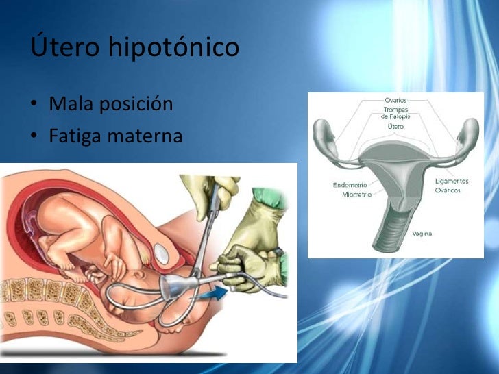 Parto distócico expo