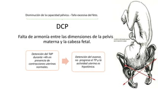 DCP
Falta de armonía entre las dimensiones de la pelvis
materna y la cabeza fetal.
Detención del TdP
durante +4h en
presencia de
contracciones uterinas
normales.
Detención del avance,
no progresa el TP y la
actividad uterina es
hipotónica.
Disminución de la capacidad pélvica.--Talla excesiva del feto.
 
