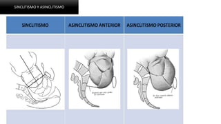 SINCLITISMO Y ASINCLITISMO
 