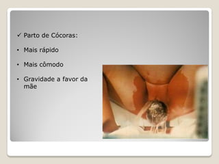  Parto de Cócoras:
• Mais rápido
• Mais cômodo
• Gravidade a favor da
mãe
 