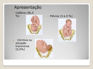 Apresentação
 Cefálica (96,5
%)
 Córmica ou
situação
transversa
(0,5%)
 Pélvica (3 a 4 %)
 