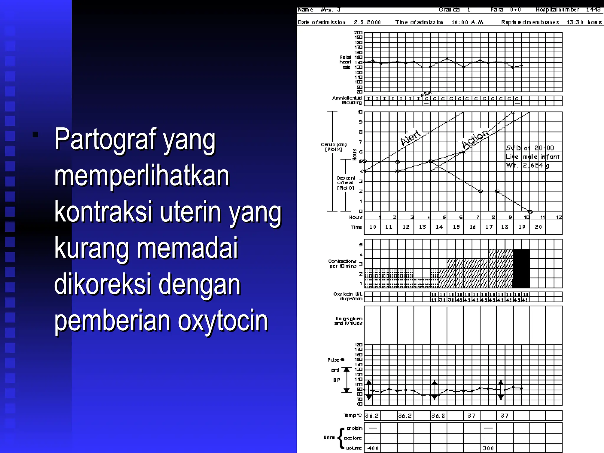 
Partograf yang
Partograf yang
memperlihatkan
memperlihatkan
kontraksi uterin yang
kontraksi uterin yang
kurang memadai
kurang memadai
dikoreksi dengan
dikoreksi dengan
pemberian oxytocin
pemberian oxytocin
 
