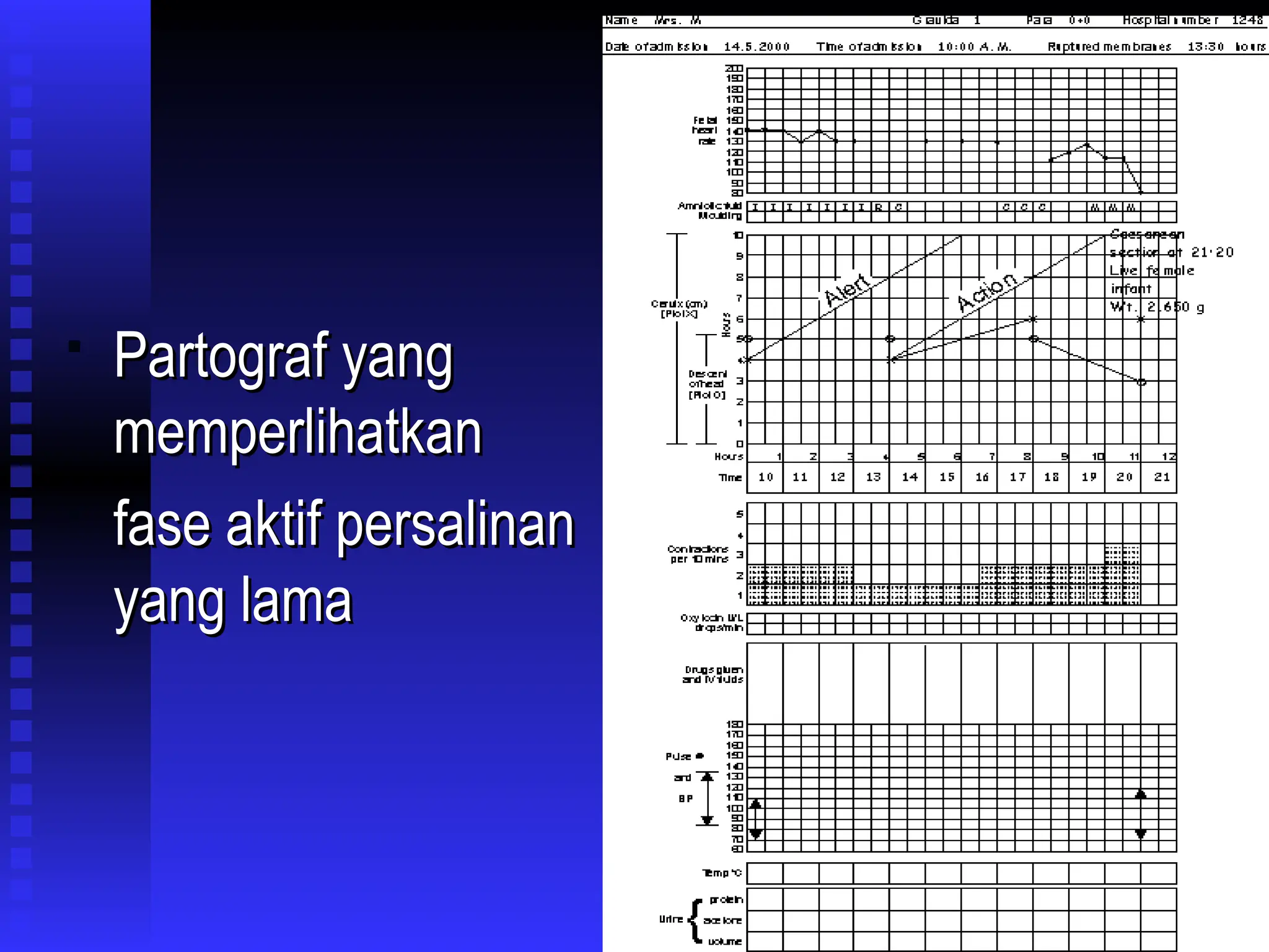 
Partograf yang
Partograf yang
memperlihatkan
memperlihatkan

fase aktif persalinan
fase aktif persalinan
yang lama
yang lama
 