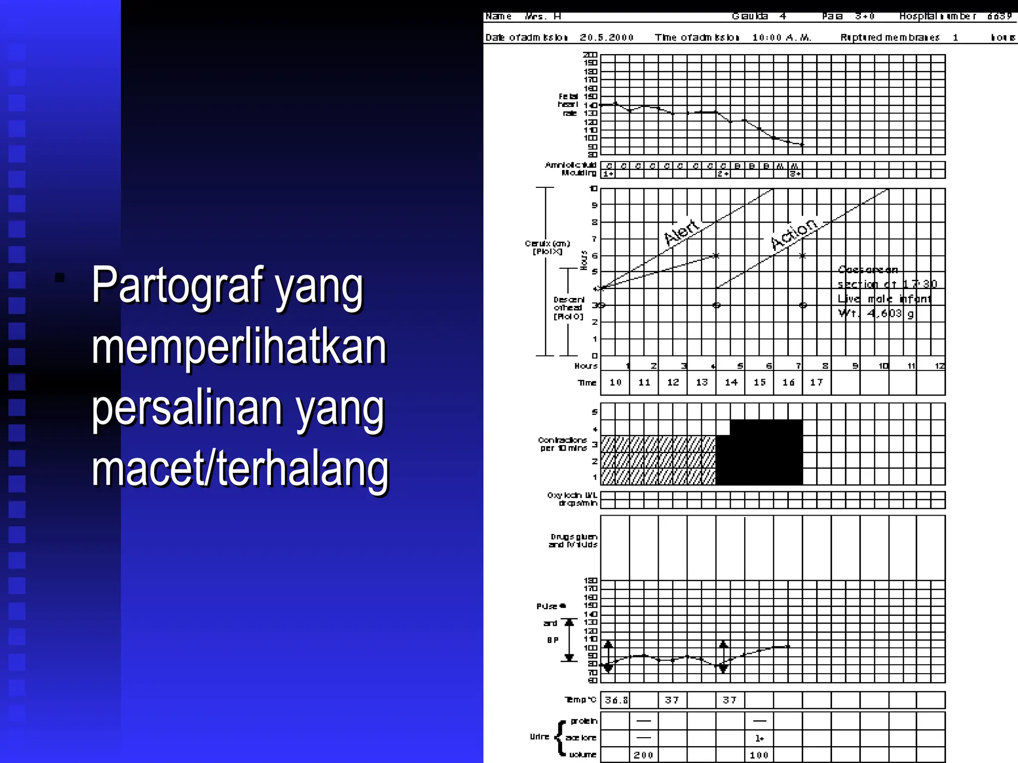 
Partograf yang
Partograf yang
memperlihatkan
memperlihatkan
persalinan yang
persalinan yang
macet/terhalang
macet/terhalang
 