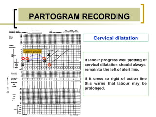 PARTOGRAM RECORDING Latent phase Cervical dilatation + + + + If labour progress well plotting of cervical dilatation should always  remain to the left of alert line. If it cross to right of action line this warns that labour may be prolonged. 