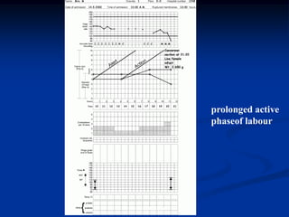 prolonged active phaseof labour 
Aboubakr Elnashar  
