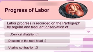 Labor progress is recorded on the Partograph
by regular and frequent observation of..
1
:
Cervical dilatation
.
2
:
Descent of the fetal head
.
3
:
Uterine contraction
.
Progress of Labor
 