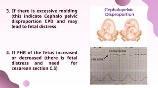 3. If there is excessive molding
(this indicate Cephalo pelvic
disproportion CPD and may
lead to fetal distress
4. If FHR of the fetus increased
or decreased (there is fetal
distress and need for
cesarean section C.S)
 