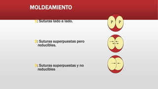 MOLDEAMIENTO
1: Suturas lado a lado.
2: Suturas superpuestas pero
reducibles.
3: Suturas superpuestas y no
reducibles
P P
 