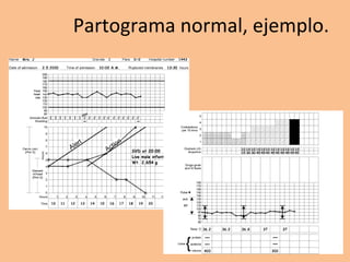 Partograma normal, ejemplo.
.
 
