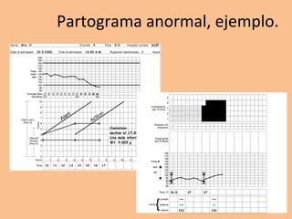 Partograma anormal, ejemplo.
.
 