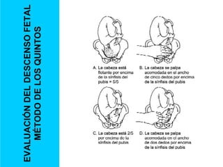 EVALUACIÓN
DEL
DESCENSO
FETAL
MÉTODO
DE
LOS
QUINTOS
 